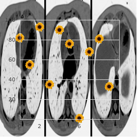 Muscular phosphorylase kinase deficiency