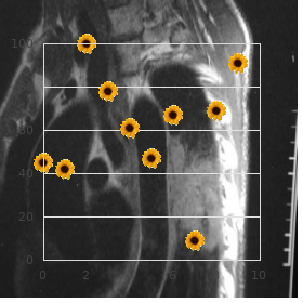 Pigmentary retinopathy