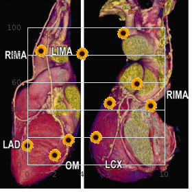 Paroxysmal ventricular fibrillation