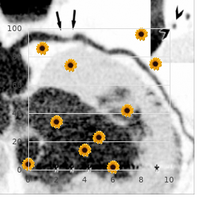 Hydrocephaly corpus callosum agenesis diaphragmatic hernia