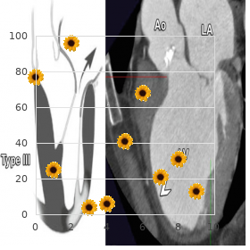 Optic atrophy opthalmoplegia ptosis deafness myopia