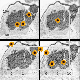 Radiation induced meningioma